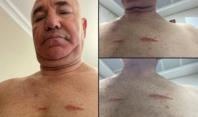 Mahmut Tanal vücudundaki darp izlerini paylaştı